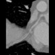 CT angiography of heart: CT - Computed tomography