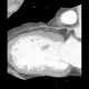 CT angiography of heart: CT - Computed tomography