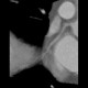 CT angiography of heart: CT - Computed tomography