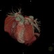 CT angiography of heart: CT - Computed tomography