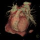 CT angiography of heart: CT - Computed tomography