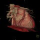 CT angiography of heart: CT - Computed tomography