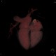 CT angiography of heart: CT - Computed tomography