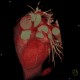 CT angiography of heart: CT - Computed tomography