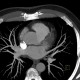 CT angiography of heart: CT - Computed tomography