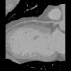 CT angiography of heart: CT - Computed tomography