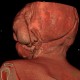 Hemangioma of face, extensive: CT - Computed tomography