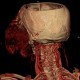 Hemangioma of face, extensive: CT - Computed tomography