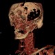 Hemangioma of face, extensive: CT - Computed tomography