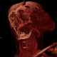 Hemangioma of face, extensive: CT - Computed tomography