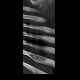 Hemangioma of rib: CT - Computed tomography