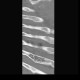 Hemangioma of rib: CT - Computed tomography