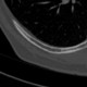 Hemangioma of rib: CT - Computed tomography
