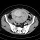 Hematometra: CT - Computed tomography