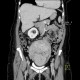 Hematometra: CT - Computed tomography