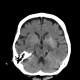 Infarction in basal ganglia, hemorrhagic transformation: CT - Computed tomography