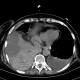 Hemothorax, pleural effusion: CT - Computed tomography