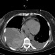 Hemothorax, pleural effusion: CT - Computed tomography
