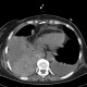 Hemothorax, pleural effusion: CT - Computed tomography