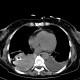 Hemothorax, pleural effusion, drainage: CT - Computed tomography