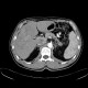 Liver tumour, 3-phase CT: CT - Computed tomography