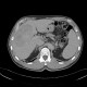 Liver tumour, 3-phase CT: CT - Computed tomography