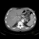 Liver tumour, 3-phase CT: CT - Computed tomography