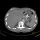Liver tumour, 3-phase CT: CT - Computed tomography