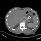 Liver tumour, 3-phase CT: CT - Computed tomography
