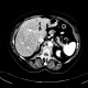 Hepatopathy after chemotherapy: CT - Computed tomography