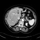 Hepatopathy after chemotherapy: CT - Computed tomography