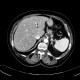 Hepatopathy after chemotherapy: CT - Computed tomography