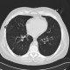 Lung hernia, centrilobular emphysema: CT - Computed tomography