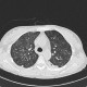 Alveolar pattern, HRCT: CT - Computed tomography