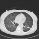 Alveolar pattern, HRCT: CT - Computed tomography