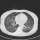 Alveolar pattern, HRCT: CT - Computed tomography