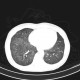 Alveolar pattern, HRCT: CT - Computed tomography