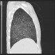 Alveolar pattern, HRCT: CT - Computed tomography