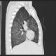 Alveolar pattern, HRCT: CT - Computed tomography