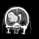 Brain hemorrhage, hypertonic, hemocephalus: CT - Computed tomography