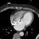 Hypodense subendocardial layer, myocardial infarction: CT - Computed tomography