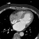 Hypodense subendocardial layer, myocardial infarction: CT - Computed tomography