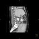 Hypoplasia of inferior vena cava, shunting by hemiazygous vein and vertebral veins: CT - Computed tomography