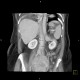 Hypoplasia of inferior vena cava, shunting by hemiazygous vein and vertebral veins: CT - Computed tomography