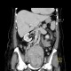 Hypoplasia of inferior vena cava, shunting by hemiazygous vein and vertebral veins: CT - Computed tomography