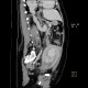 Hypoplasia of inferior vena cava, shunting by hemiazygous vein and vertebral veins: CT - Computed tomography