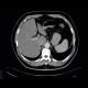 Hemangioma, CEUS: CT - Computed tomography