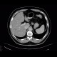 Hemangioma, CEUS: CT - Computed tomography