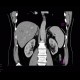 Hemangioma, CEUS: CT - Computed tomography