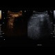 Hemangioma, CEUS: US - Ultrasound